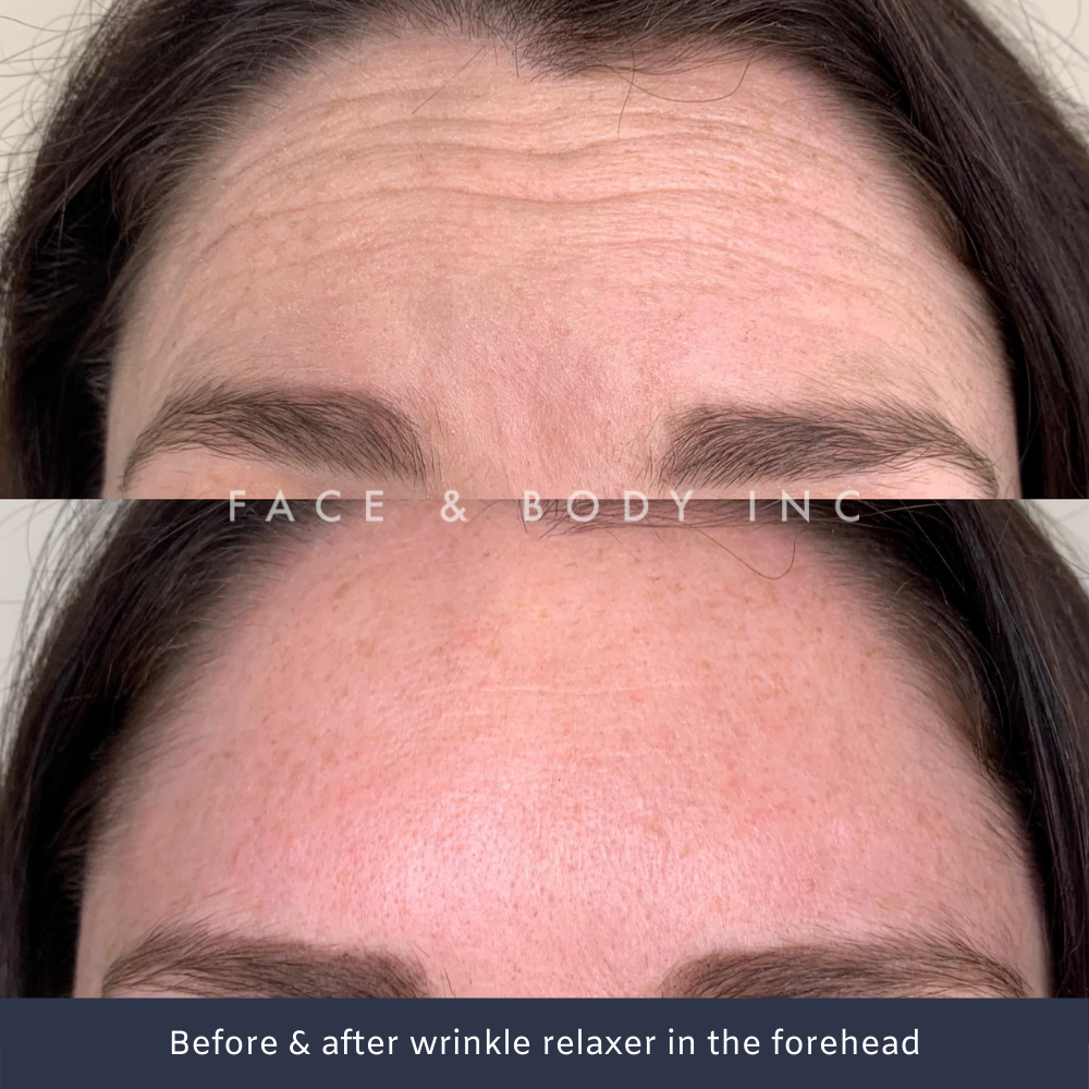 Wrinkle Relaxers Perth Anti Wrinkle Injections Face and Body Inc