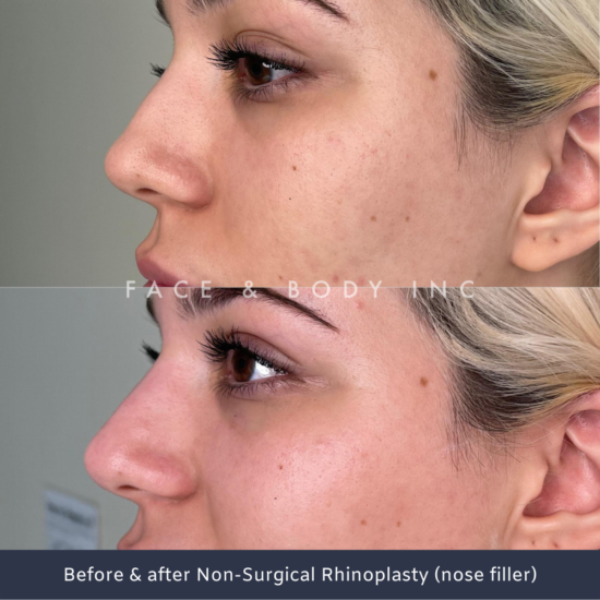 Nose Filler Perth - Face and Body Inc