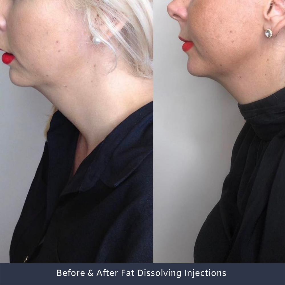 Double Chin Injections Perth