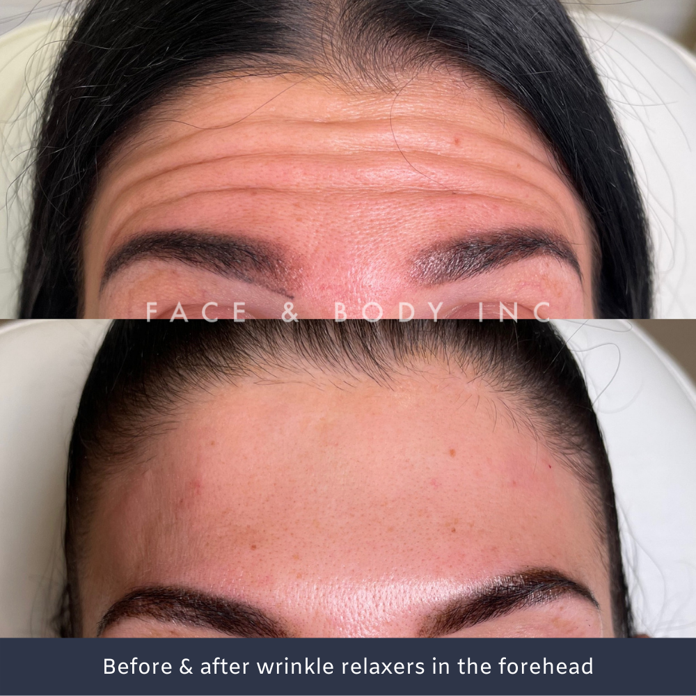 Forehead Wrinkle Relaxers