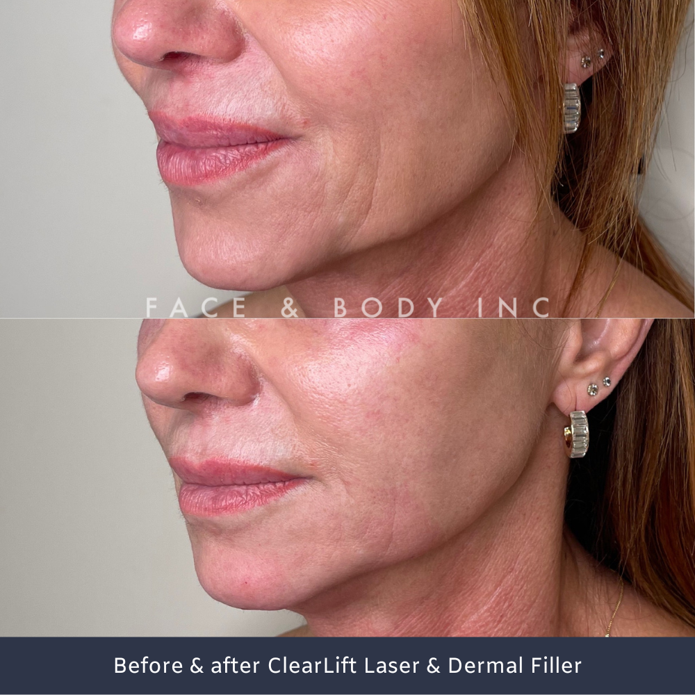 ClearLift Laser Perth