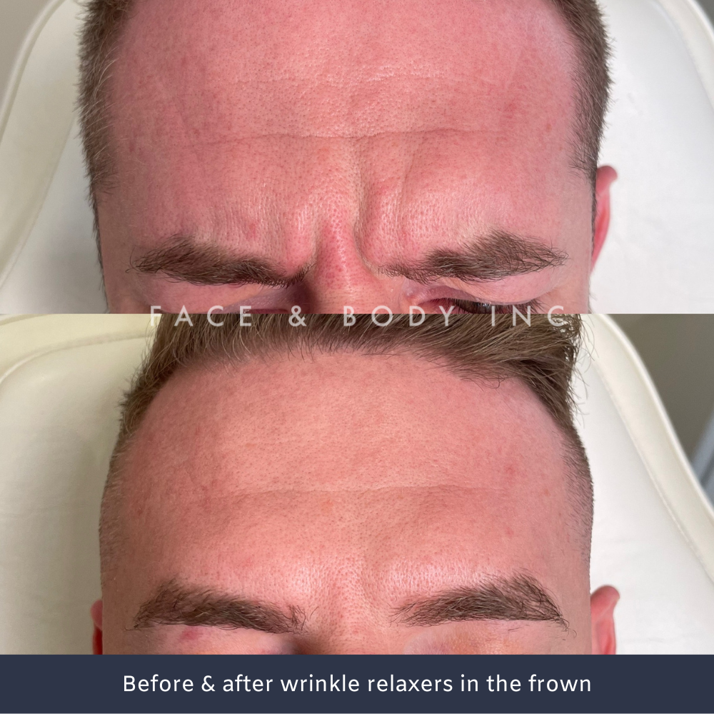 Male Wrinkle Relaxers Perth