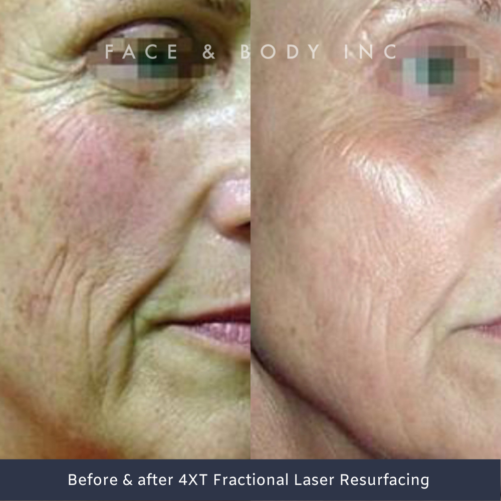 Laser Resurfacing before and afters