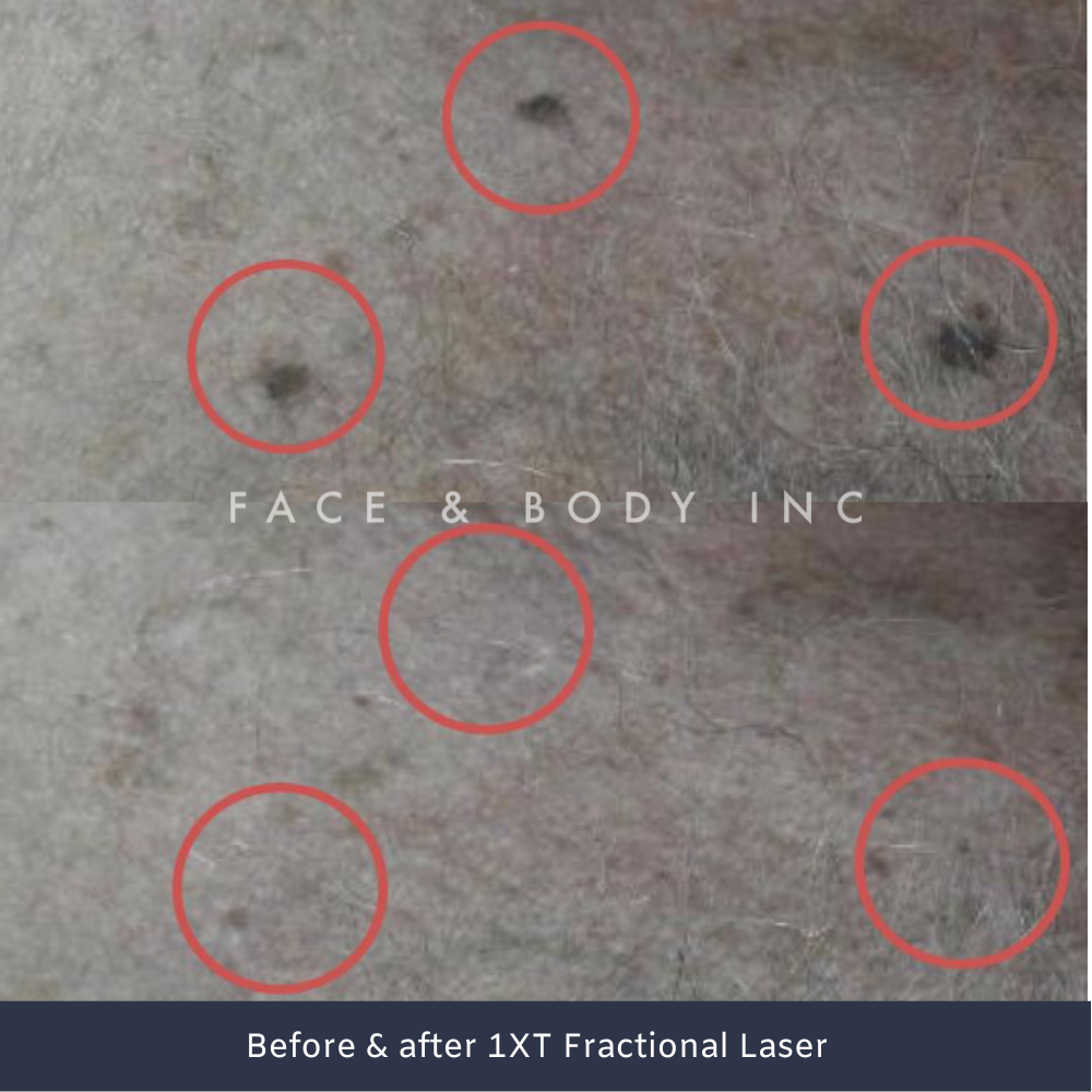 Laser Resurfacing before and afters