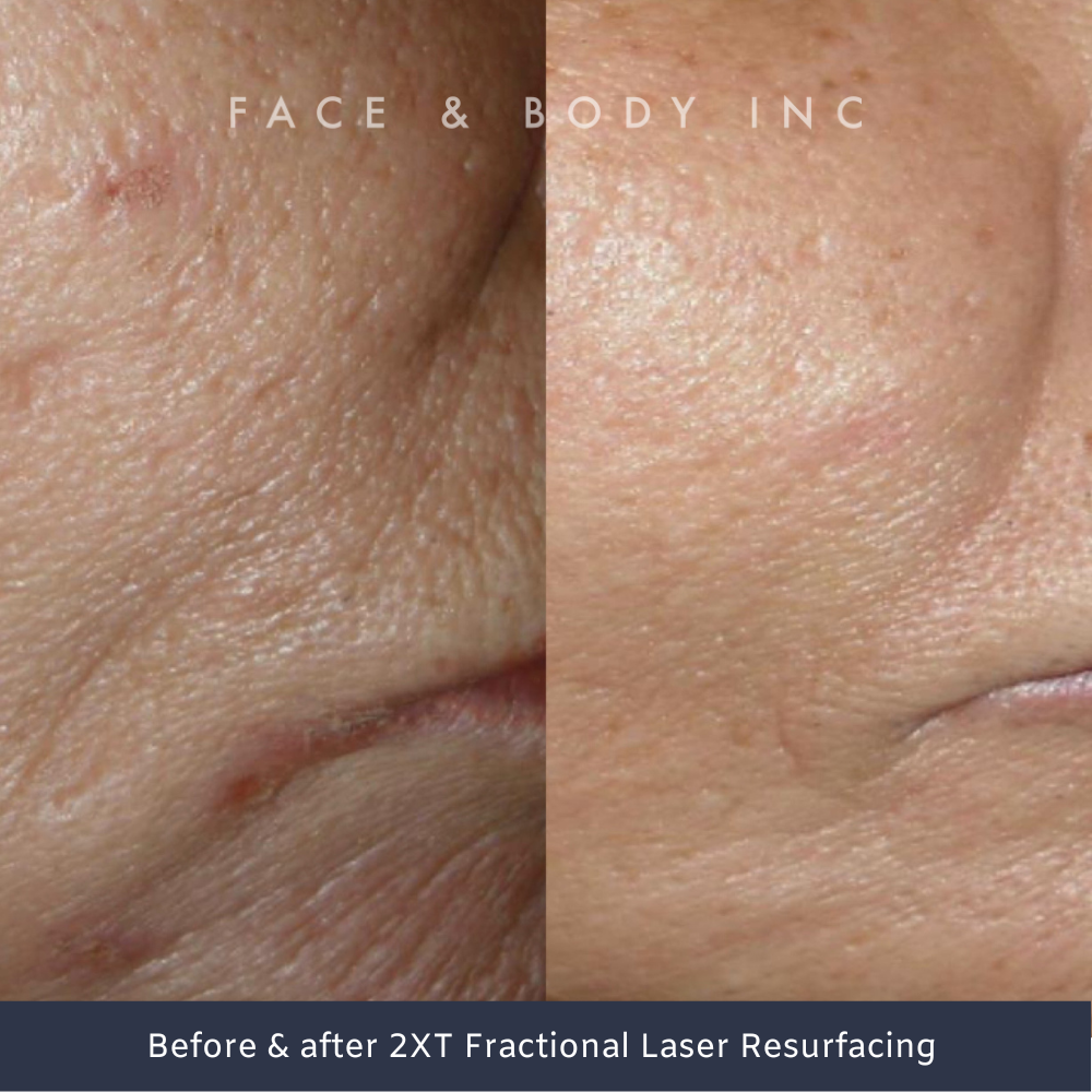 IPixel Laser Skin Resurfacing Perth Face And Body Inc