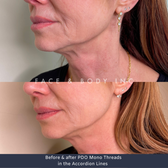 PDO Mono Threads Perth Face and Body Inc