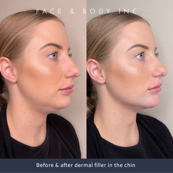 Chin Fillers Perth Face and Body Inc
