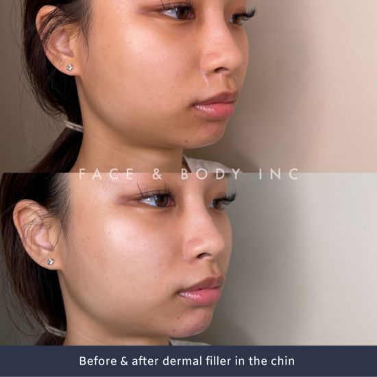 Chin Fillers Perth Face and Body Inc