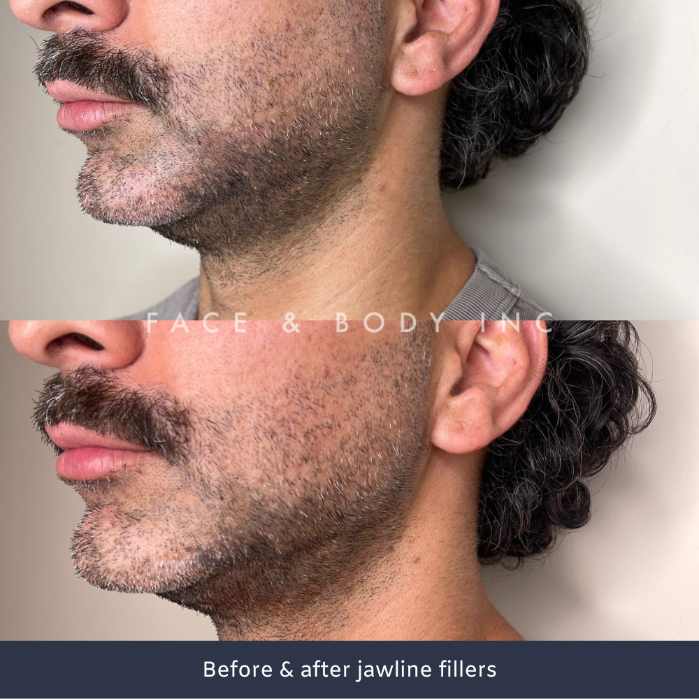 Male jawline fillers Perth