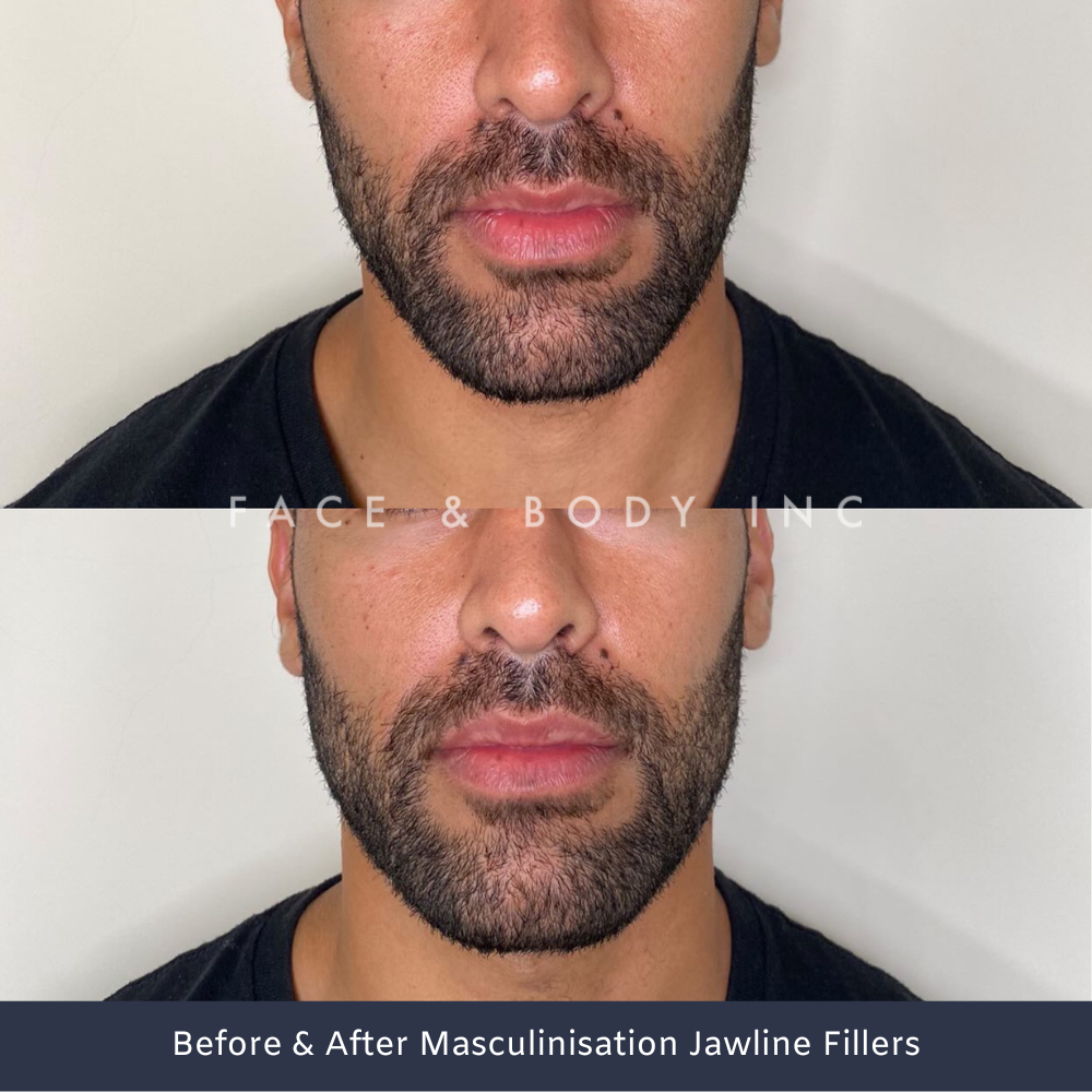 Male Jawline Fillers Perth