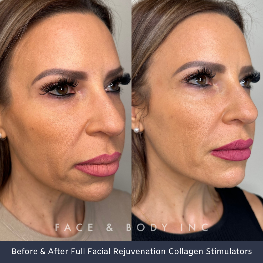 Full Facial Rejuvenation Collagen Stimulators Perth