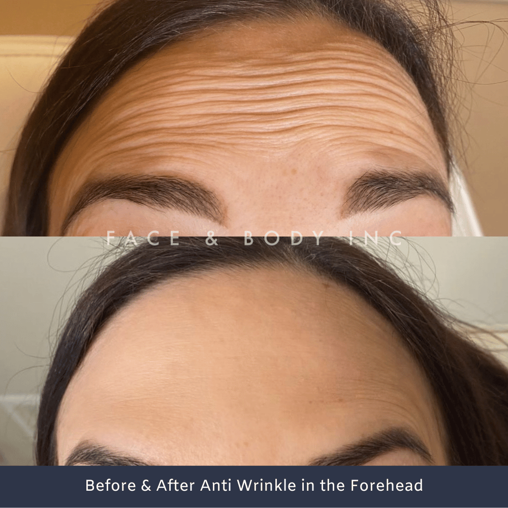 Wrinkle Relaxers Forehead Perth