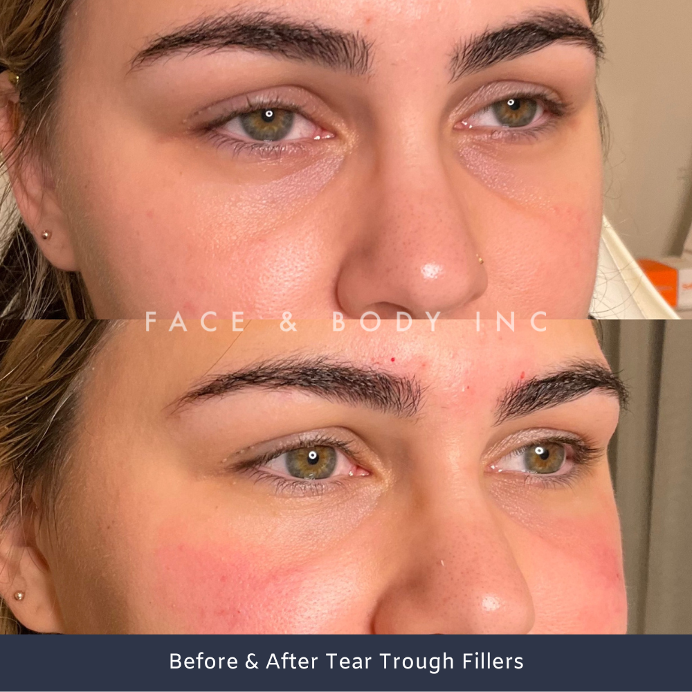 Before & After Tear Trough Fillers Perth