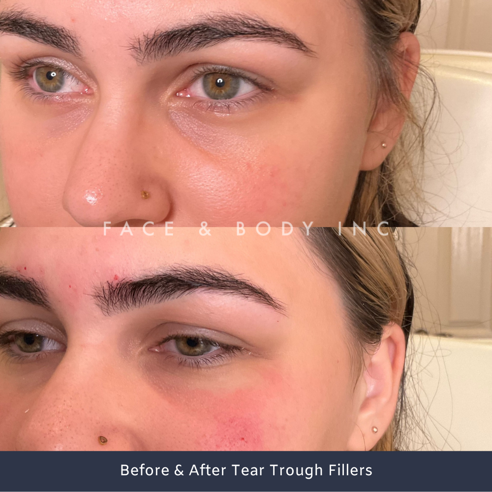 Before & After Tear Trough Fillers Perth