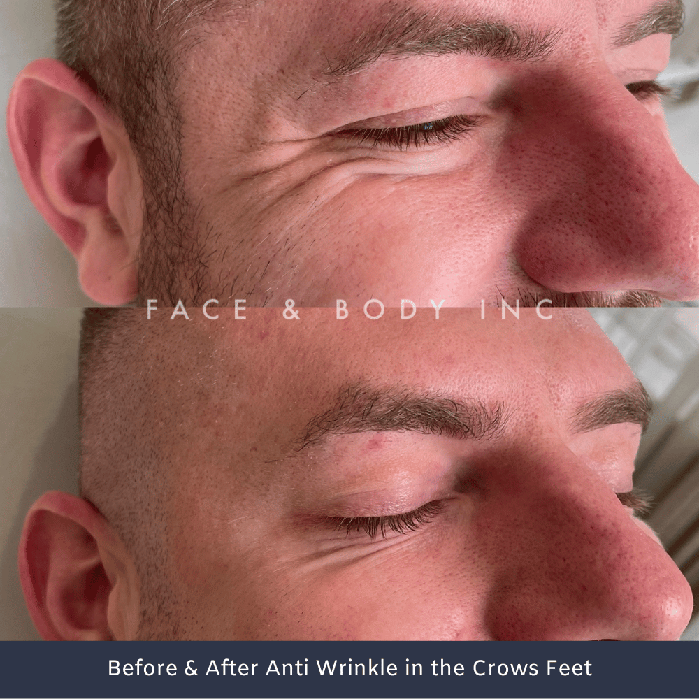 Wrinkle Relaxers Crows Feet Perth