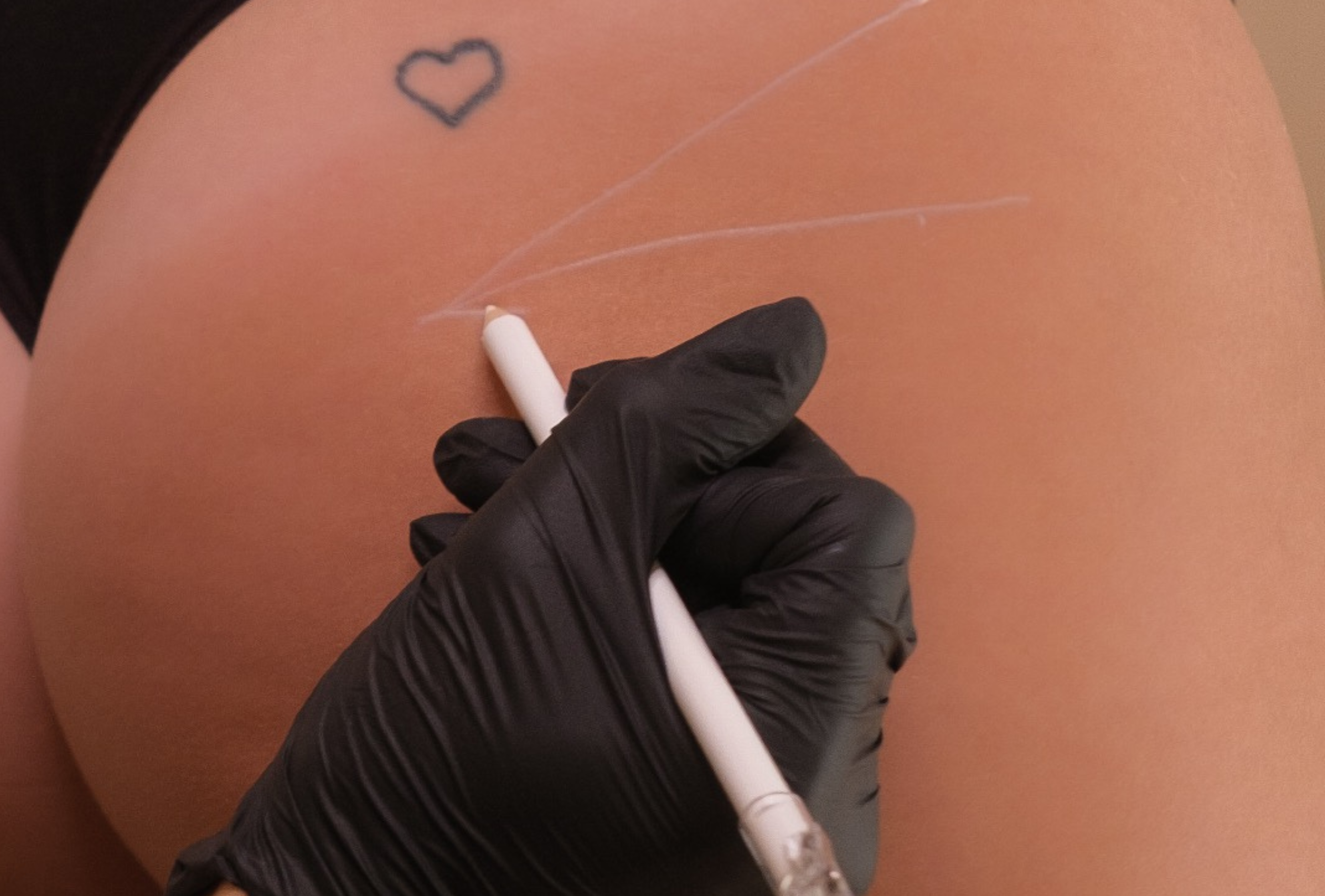 Non-Surgical Butt Lift Perth