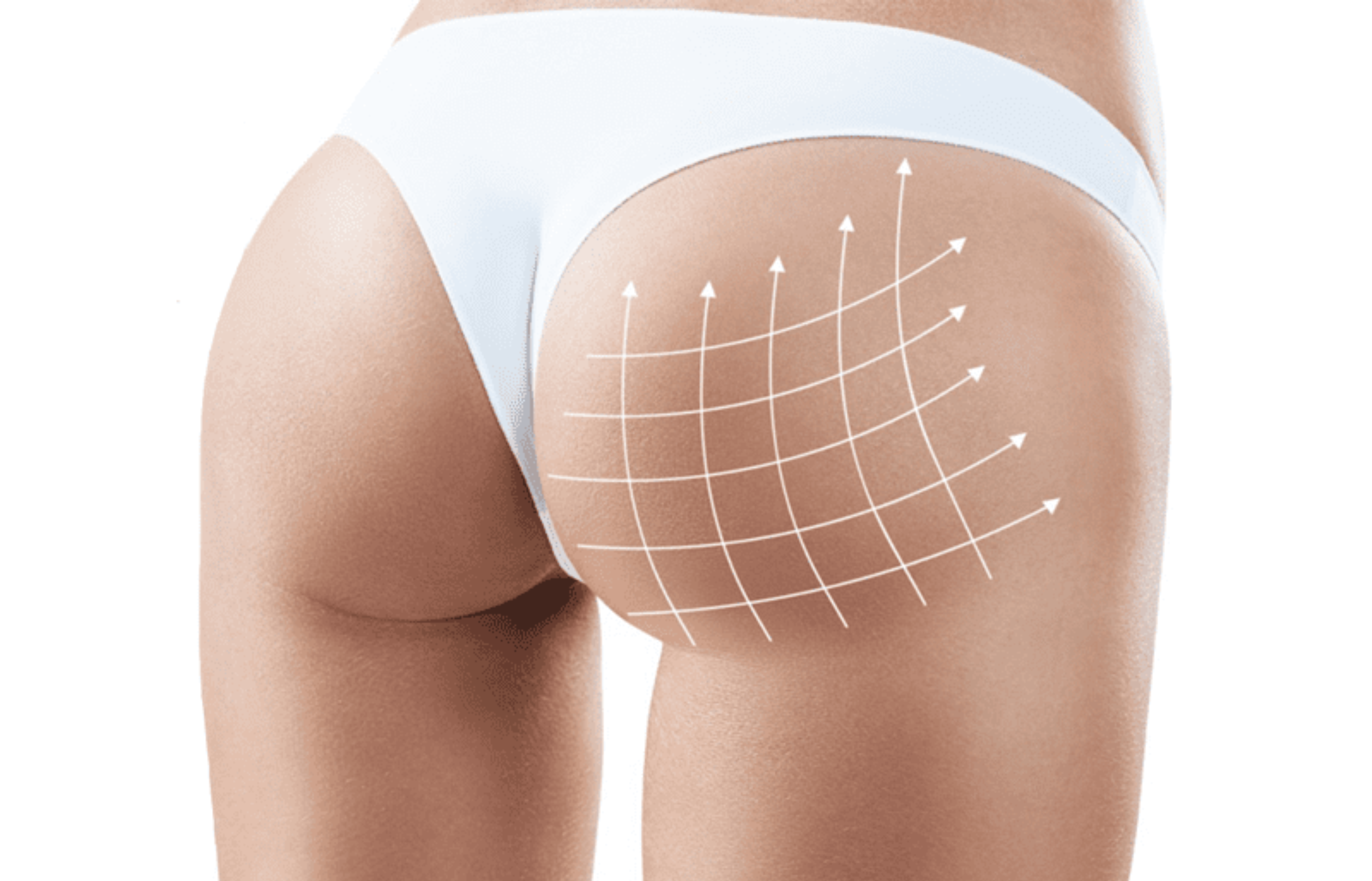 Non-Surgical Butt lift Perth