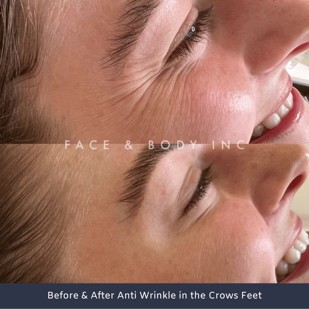 Wrinkle Relaxers Crows Feet Perth
