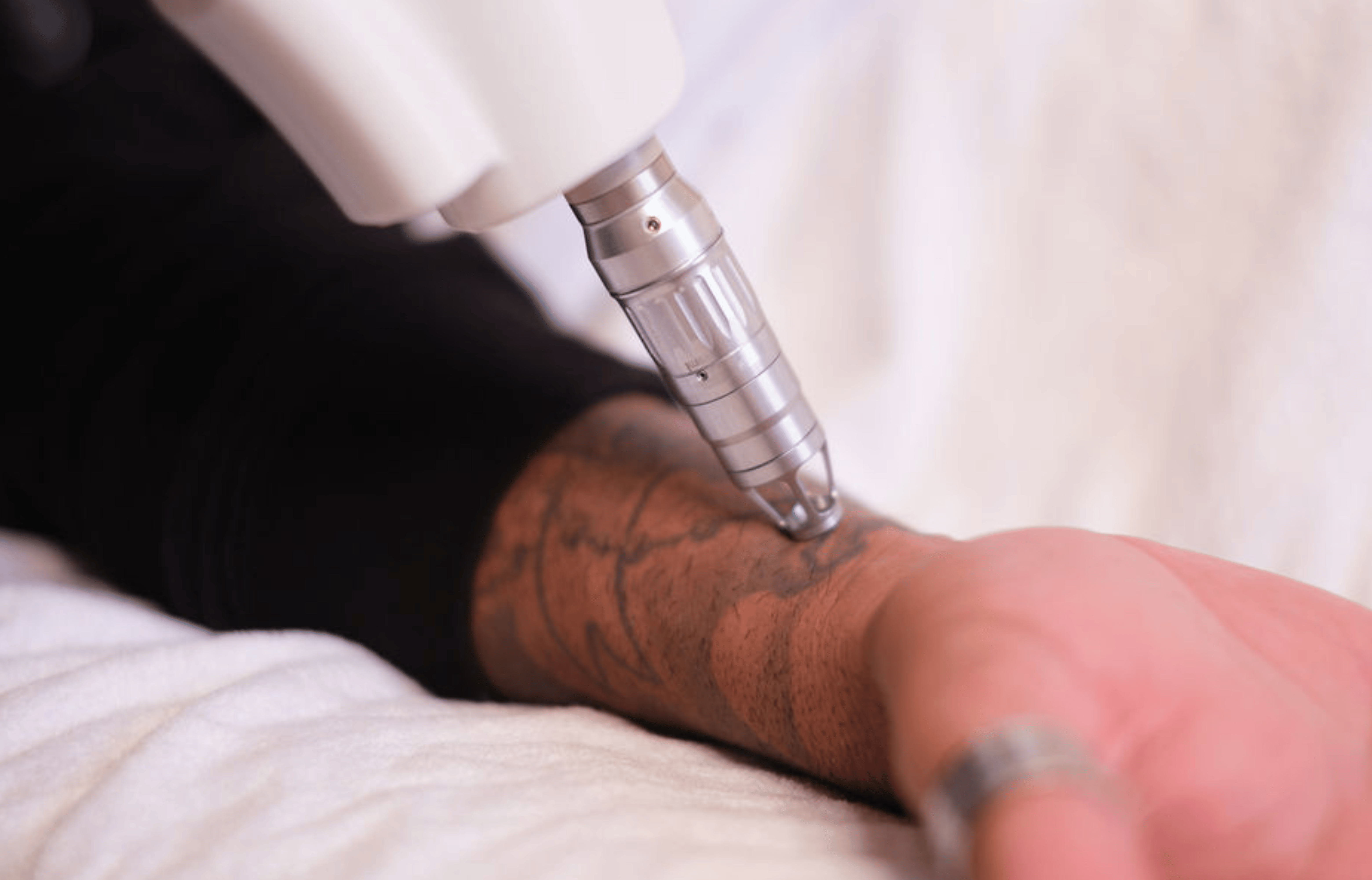 Laser Tattoo Removal Perth