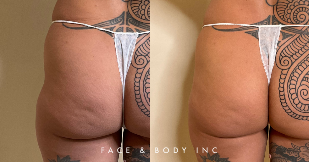Hip Dip Fillers Before & Afters