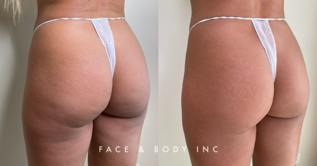 Non-surgical-butt-lift-before and after