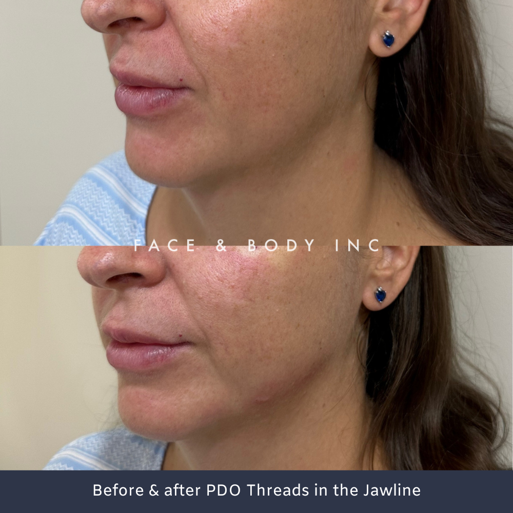 Before & After PDO Threads Jawline Perth