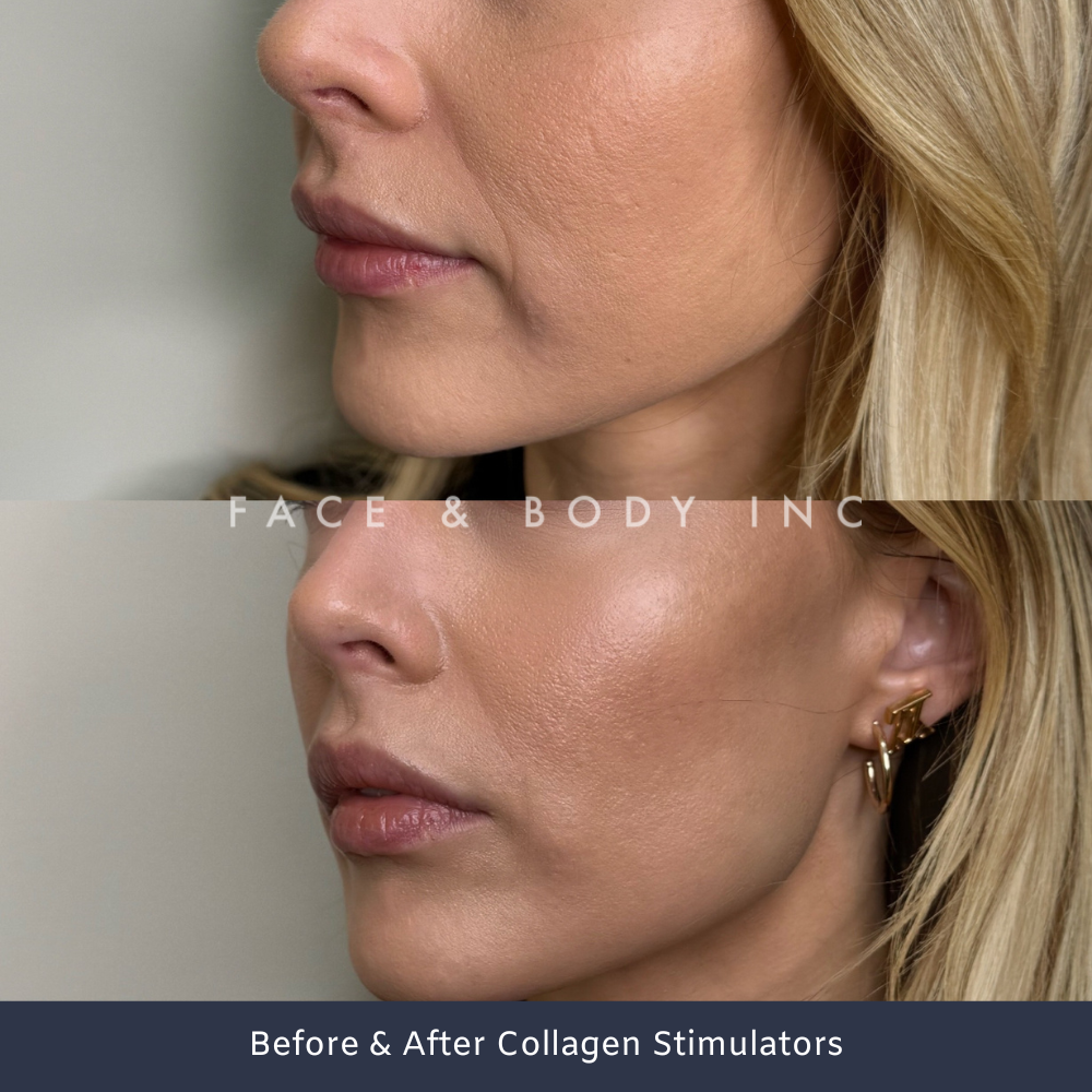 Before & After Collagen Stimulators Perth