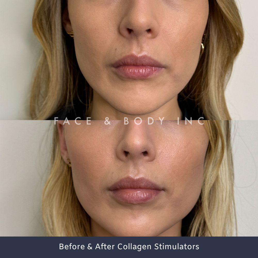 Before & After Collagen Stimulators Perth