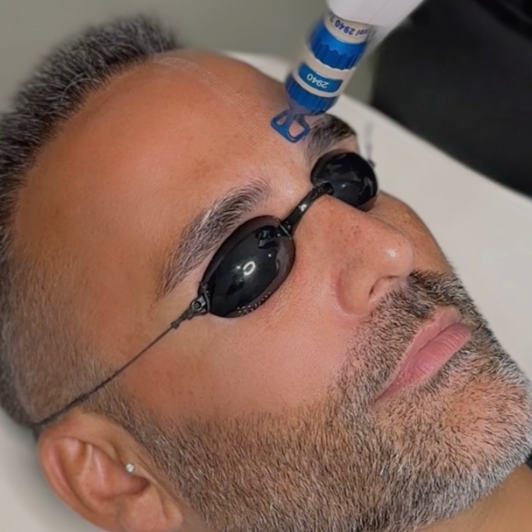 iPixel Laser Skin Resurfacing Perth
