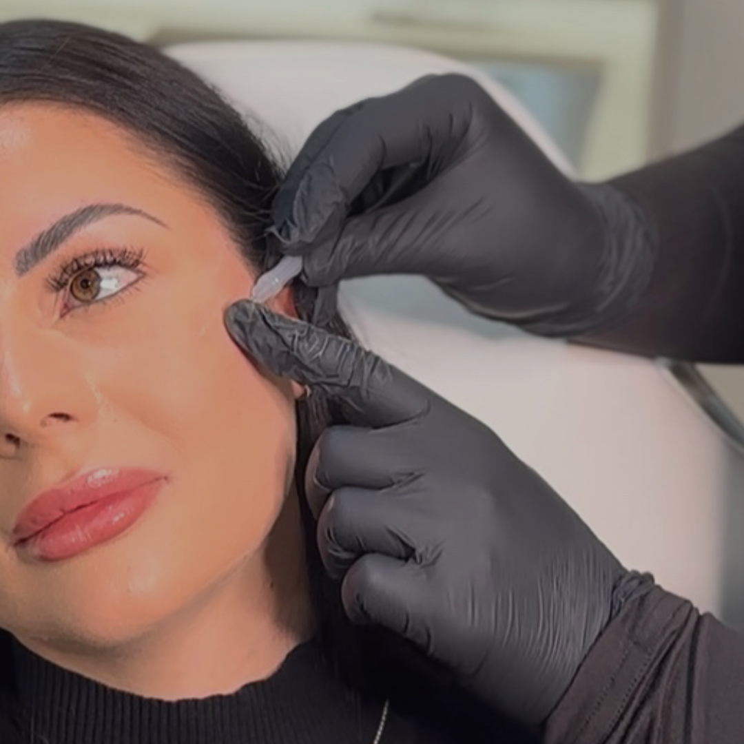 PDO Thread Lifts Perth. PDO Thread Lift Packages Perth